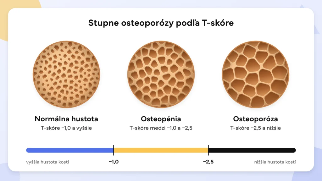 Stupne osteoporózy podľa T-skóre – normálna hustota kostí (−1,0 a vyššie), osteopénia (medzi −1,0 a −2,5) a osteoporóza (−2,5 a nižšie)