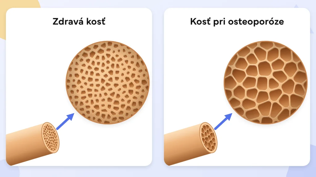 Porovnanie zdravej kosti a kosti pri osteoporóze – zdravá kosť má husté vnútorné štruktúry, pri osteoporóze sú dutiny väčšie a steny tenšie